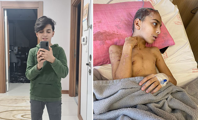 Sokak köpeklerinin saldırdığı Enes, 9 ameliyatla yaşama tutundu 