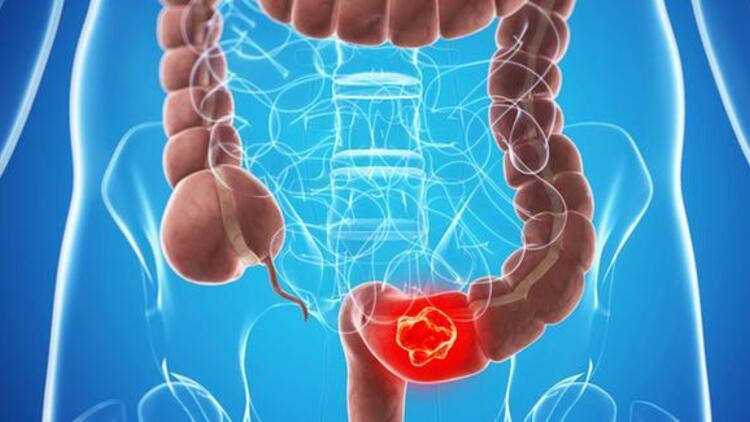Kalın bağırsak kanseri tarama programları ile önlenebiliyor