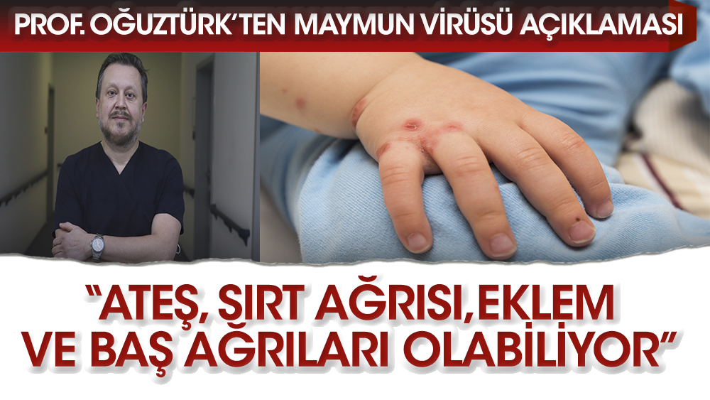 Prof. Oğuztürk'ten maymun çiçeği virüsü uyarısı