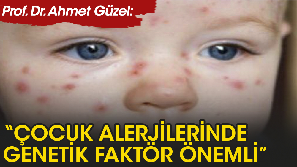 Prof. Güzel: Çocuk alerjilerinde genetik faktörler yüzde 30-50 oranında etkiliyor