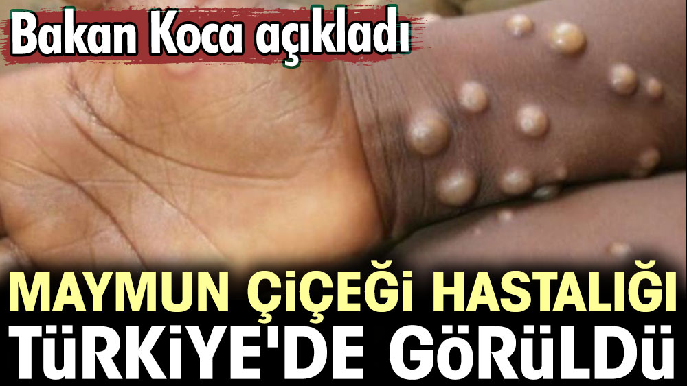 Bakan Koca açıkladı: Maymun Çiçeği hastalığı Türkiye'de görüldü