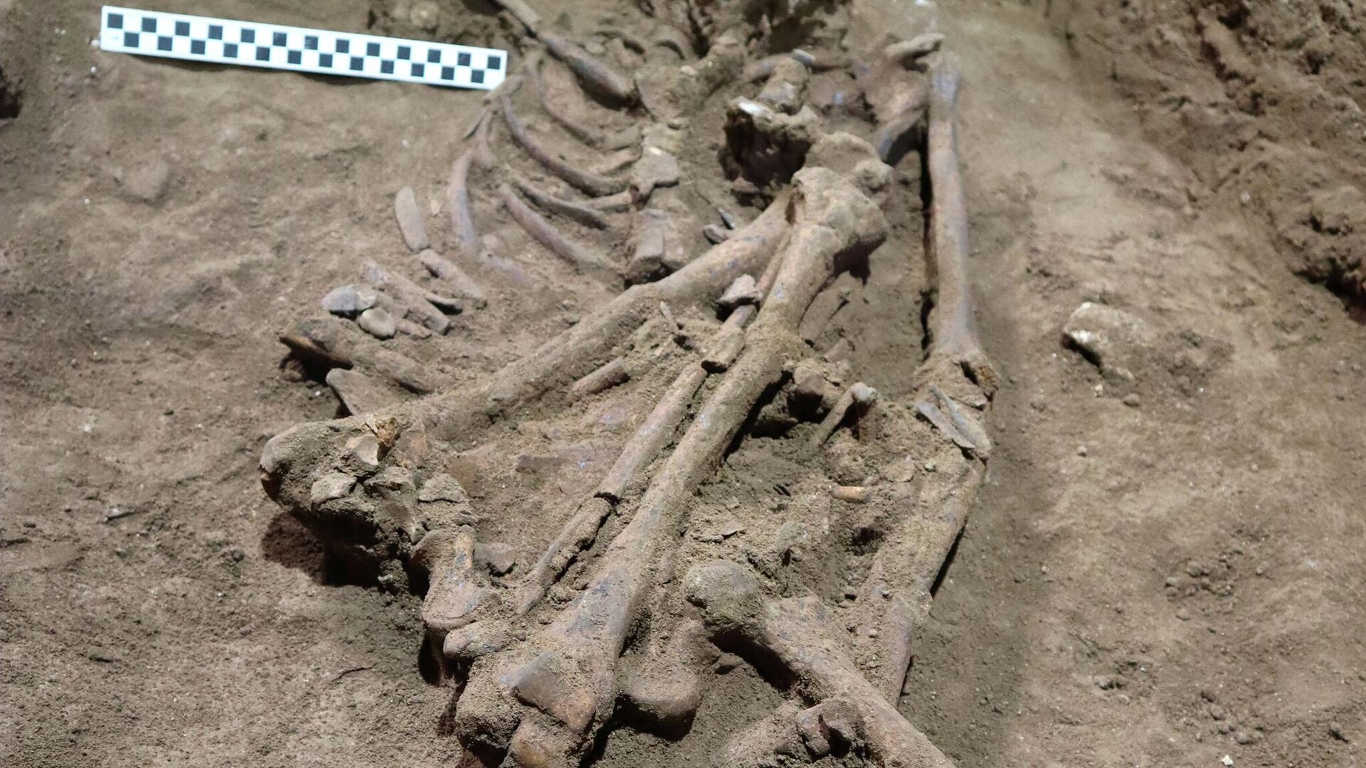 31 bin yıl öncesine ait iskelet, tarihin ilk amputasyonunu ışık tuttu
