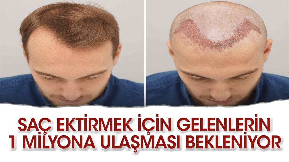Türkiye saç ekim merkezi