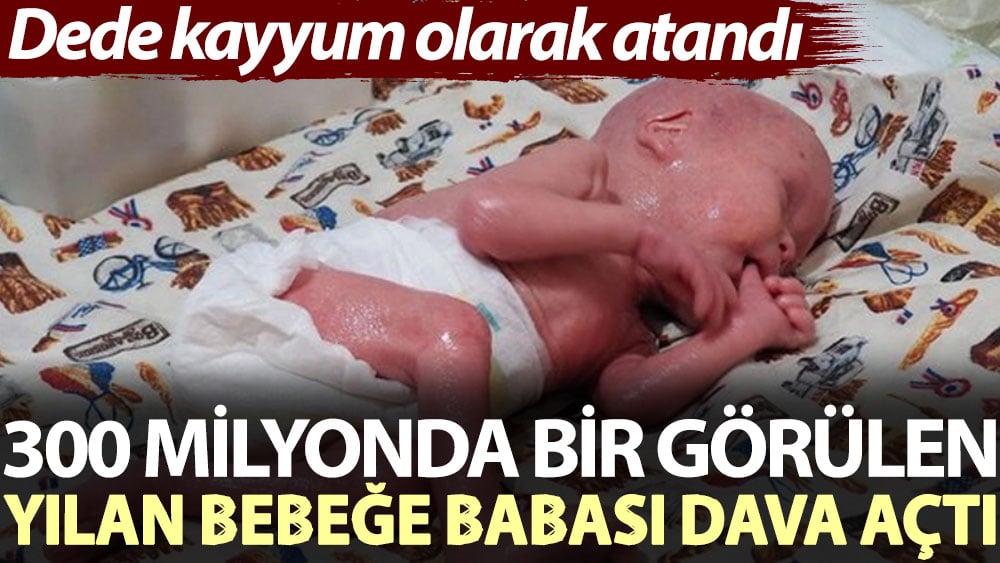 300 milyonda bir görülen 'yılan bebeğe' babası dava açtı! Dede kayyum olarak atandı