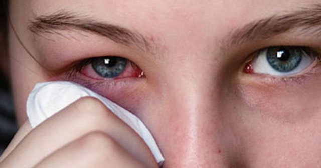 Göz kızarıklığı neden, nasıl olur? Göz kızarıklığının tedavisi nedir?