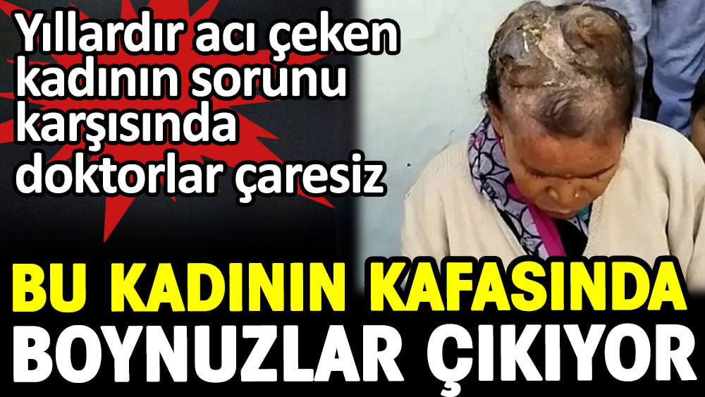 Doktorlar çaresiz. Bu kadının kafasında boynuzlar çıkıyor