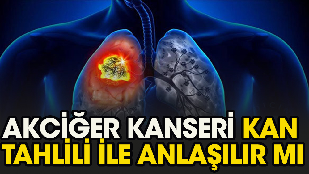Akciğer kanseri kan tahlili ile anlaşılır mı?