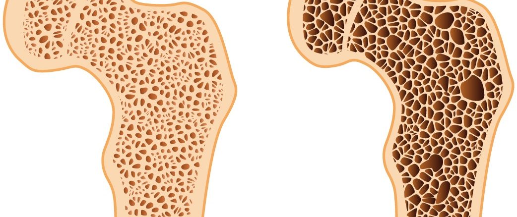 Genç yaşta kemik erimesi nasıl olur; ne yapmalı?