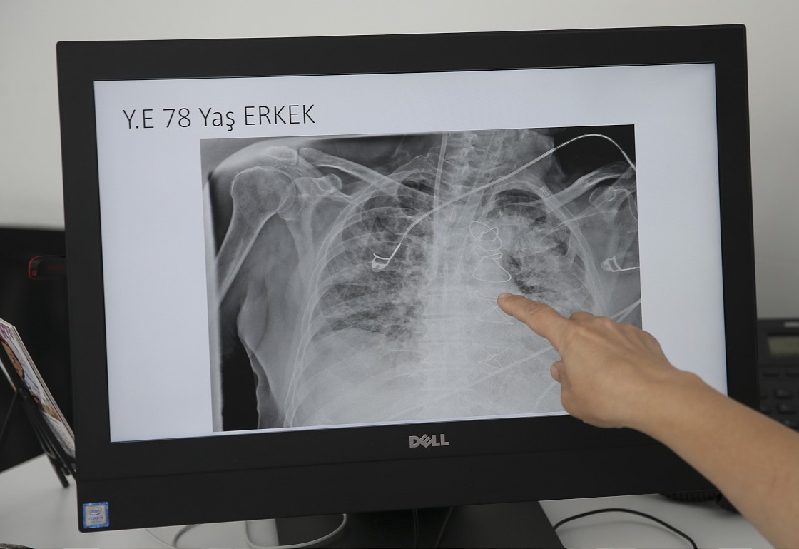 Akciğer enfeksiyonu tedavi yöntemleri nelerdir?