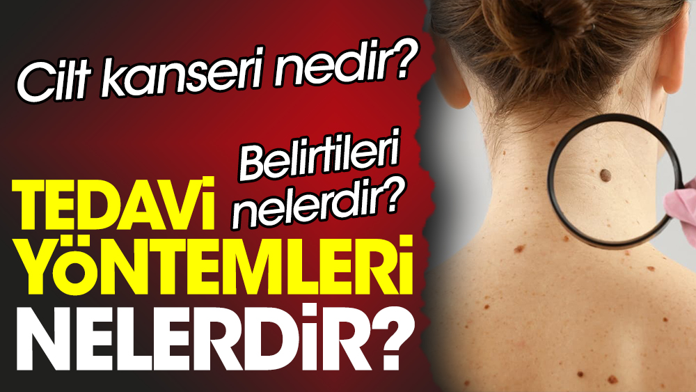 cilt kanseri nedir