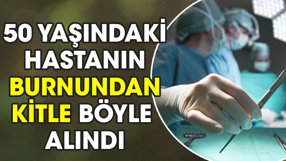 50 yaşındaki hastanın burnundan 8 santimetrelik kitle alındı