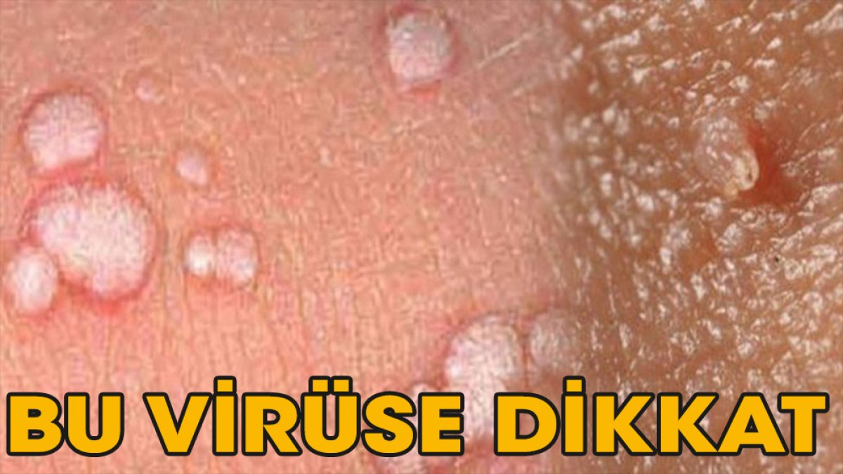 HPV virüsü araştırması