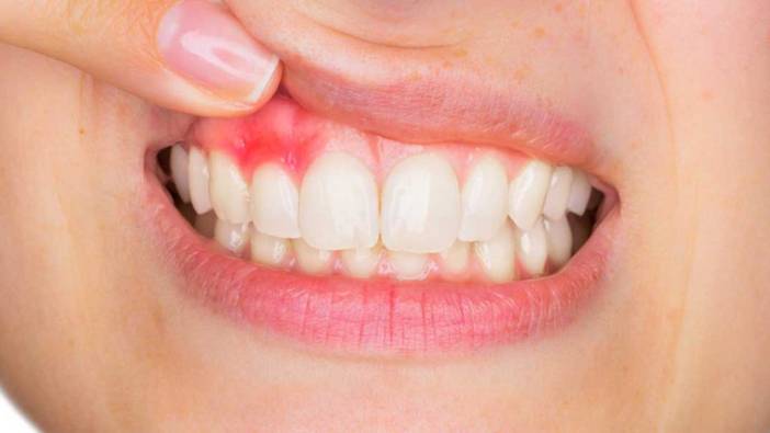 Diş iltihabında mediastinit riski