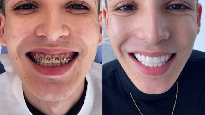 ‘Hollywood Smile' e ilgi artıyor