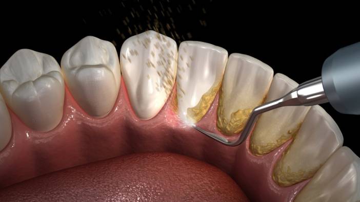 Evde diş taşı temizliği nasıl yapılır
