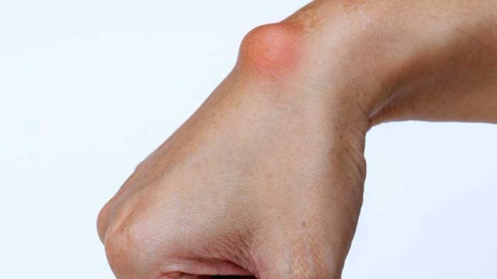 Ganglion kisti nedir