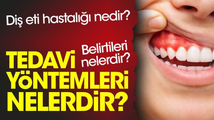 Diş eti hastalığı nedir? Belirtileri nelerdir? Tedavi yöntemleri nelerdir?