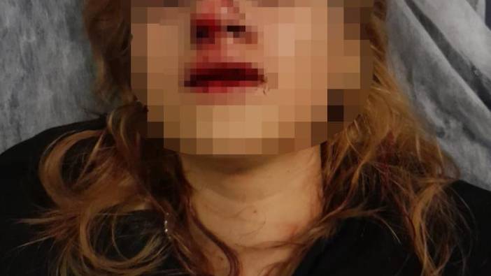 Güpe gündüz sarkıntılık edip 15 yaşındaki kızın yüzüne kaldırım taşı ile vurdular. Bu ülkenin polisi savcısı nerede bulun bu alçakları