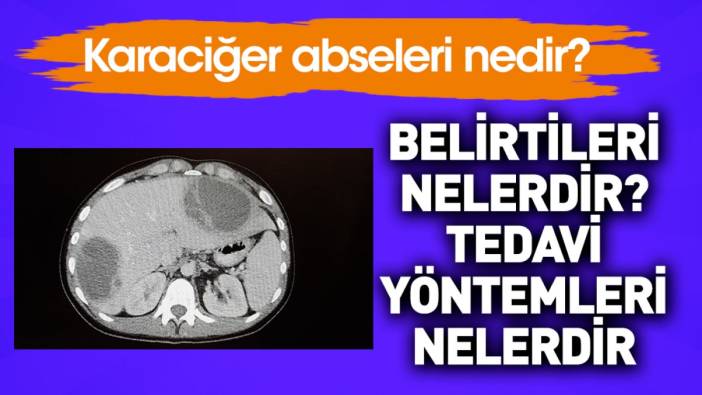 Karaciğer abseleri nedir? Belirtileri nelerdir? Tedavi yöntemleri nelerdir?