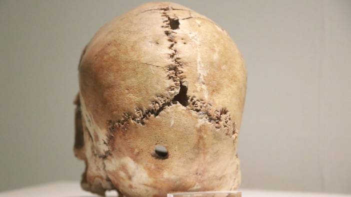 İlk beyin ameliyatına ait kafatası Türkiye'de bulundu. Tam 10 bin 500 yıllık