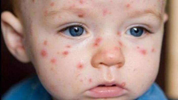 Çocuk alerjileri genetik midir