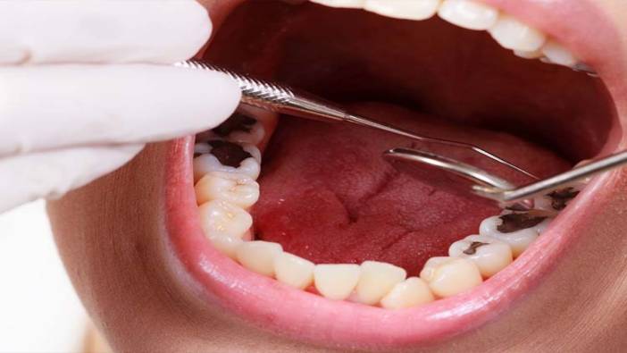 Diş çürükleri nasıl önlenir