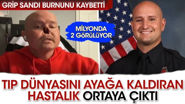 Grip sandı burnunu kaybetti. Milyonda 2 görülüyor. Tıp dünyasını ayağa kaldıran hastalık ortaya çıktı