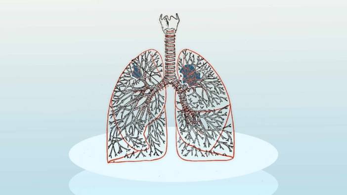 Akciğerde kitle olması nedir