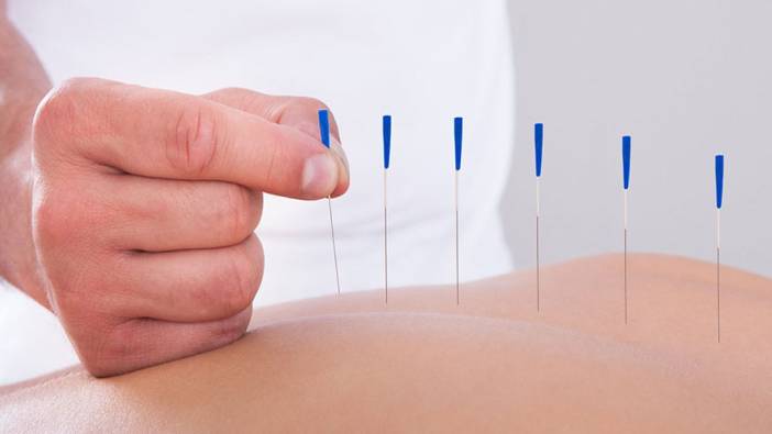 Akupunktur yararlı mı