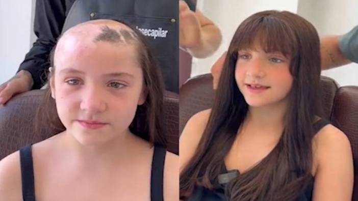Yangında saçını kaybeden kız çocuğuna protez saç uygulaması yapıldı