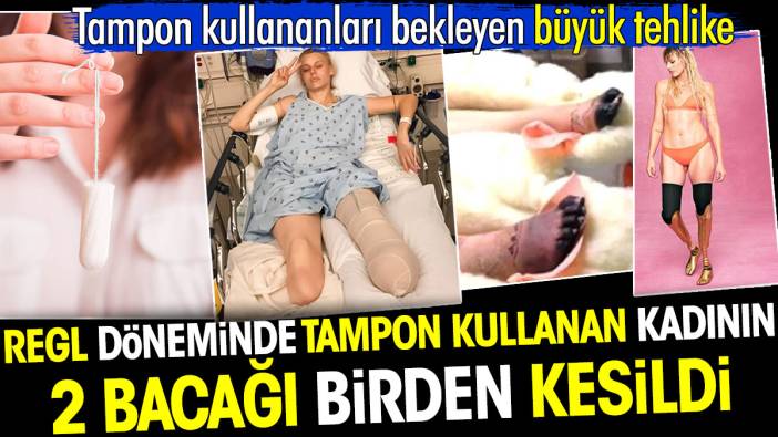 Regl döneminde tampon kullanan kadının 2 bacağı kesildi. Tampon kullananları bekleyen büyük tehlike