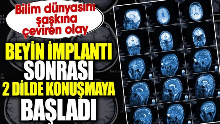 Beyin implantı sonrası 2 dilde konuşmaya başladı. Bilim dünyasını şaşkına çeviren olay