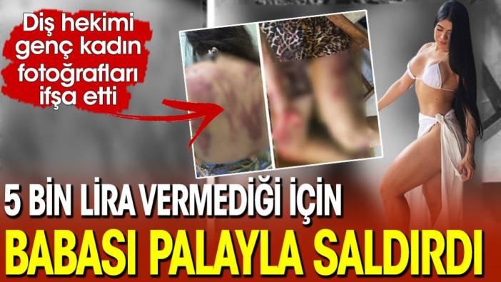 Diş hekimi genç kadın ifşa etti! 5 bin lira vermediği için babası palayla saldırdı