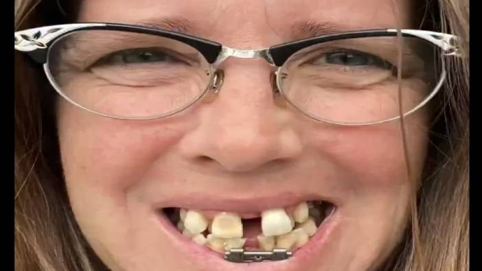 Diş tedavisi sonrası bambaşka birisi oldu