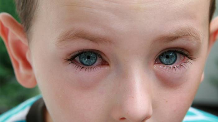 Çocuklardaki göz kızarılıkları hangi hastalıkların habercisi? Uzmanlar ve bilimsel bulgular ne diyor?