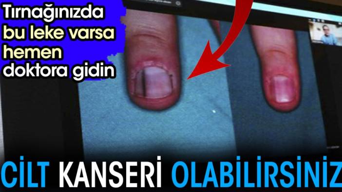 Tırnağınızda bu leke varsa hemen doktora gidin. Cilt kanseri olabilirsiniz