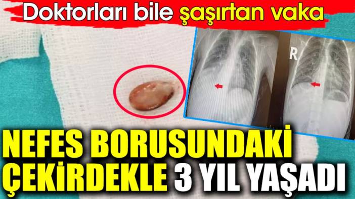 Nefes borusundaki çekirdekle 3 yıl yaşadı. Doktorları bile şaşırtan vaka