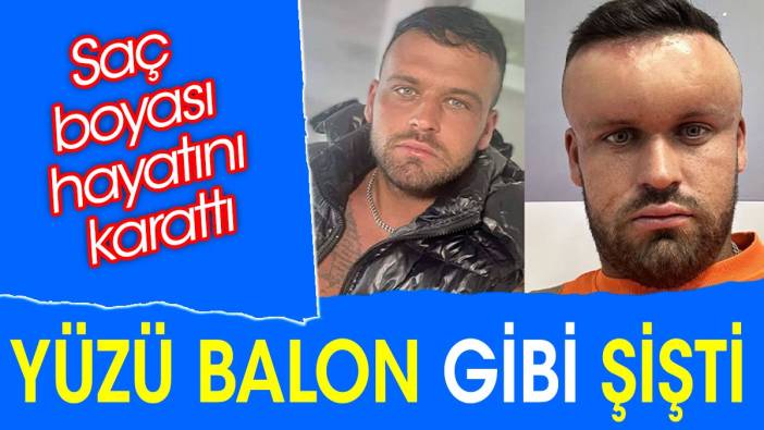 Yüzü balon gibi şişti. Saç boyası hayatını karattı