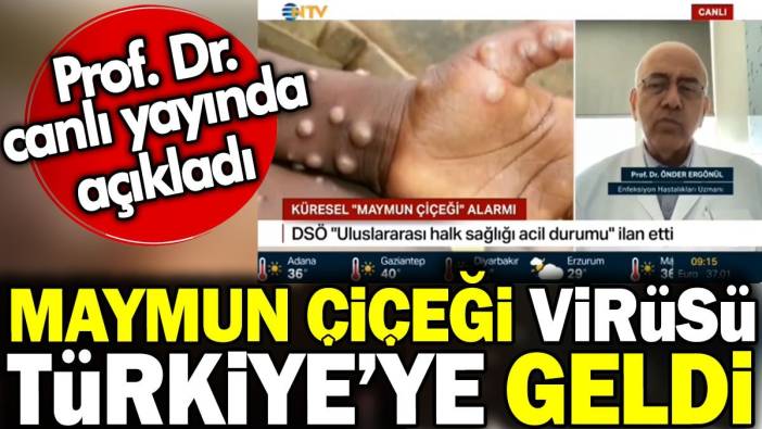 Maymun çiçeği virüsü Türkiye'ye geldi! Prof. Dr. canlı yayında açıkladı