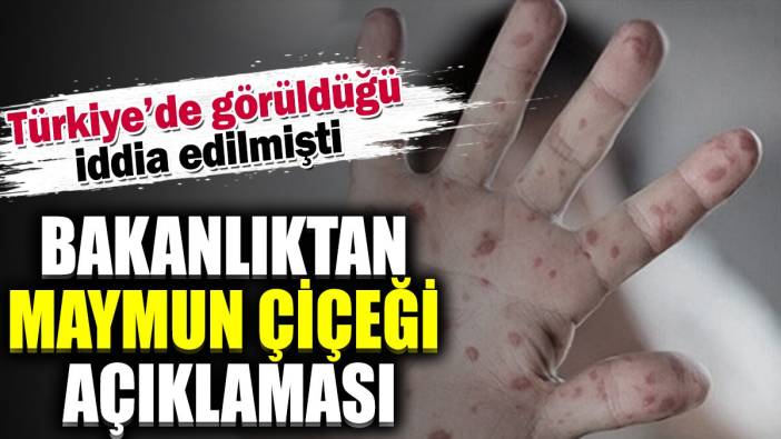 Sağlık Bakanlığı'ndan maymun çiçeği açıklaması. Türkiye'de görüldüğü iddia edilmişti