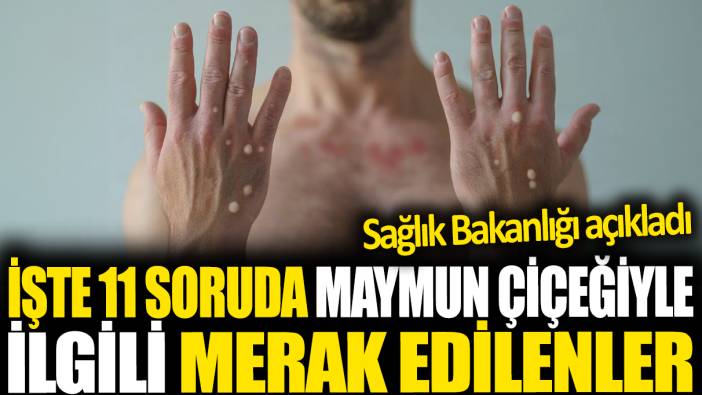 İşte 11 soruda maymun çiçeğiyle ilgili merak edilenler. Sağlık Bakanlığı açıkladı