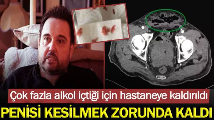 Çok fazla alkol içtiği için penisi kesilmek zorunda kaldı