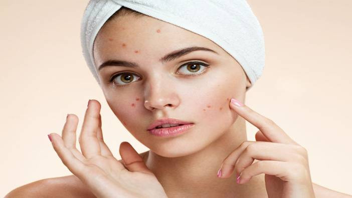 Sivilceyi bitiren üç ot! Sivilceye karşı bitkisel devrim