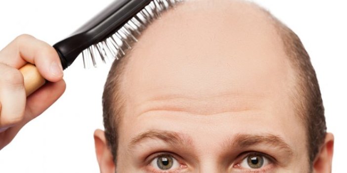 Saç dökülmesine ne sebep olur, nasıl önlenir?
