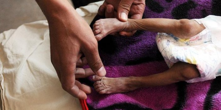 Milyonlarca Yemenli aç uyuyor