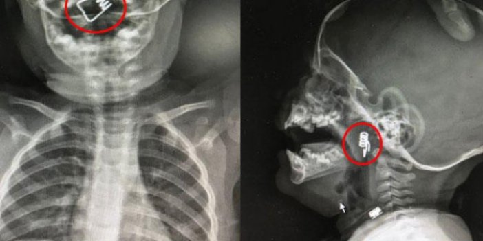 1 yaşındaki bebeğin boğazında tespit edildi