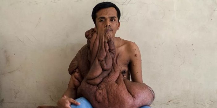 Bu adamı gören gözlerine inanamıyor: 40 kilo tümör ile dolaşıyor