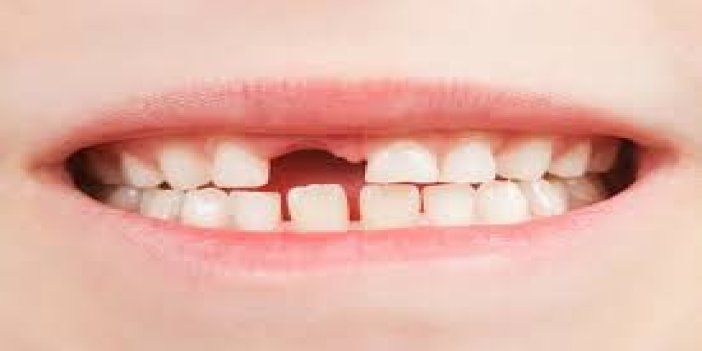Eksik dişler, ağız ve dil kanserine yol açabilir