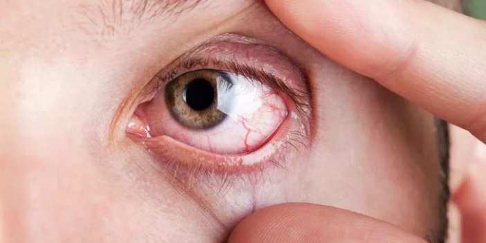 Gözleri bahar alerjisinden nasıl koruruz? İşte 8 yolu...