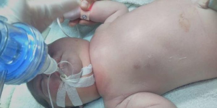 Doğumda köprücük kemiği kırılan bebek entübe edildi! Aile hastane ve doktor hakkında suç duyurusunda bulundu